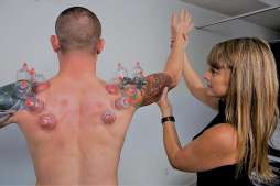 Cupping. What is it and how can it help you?